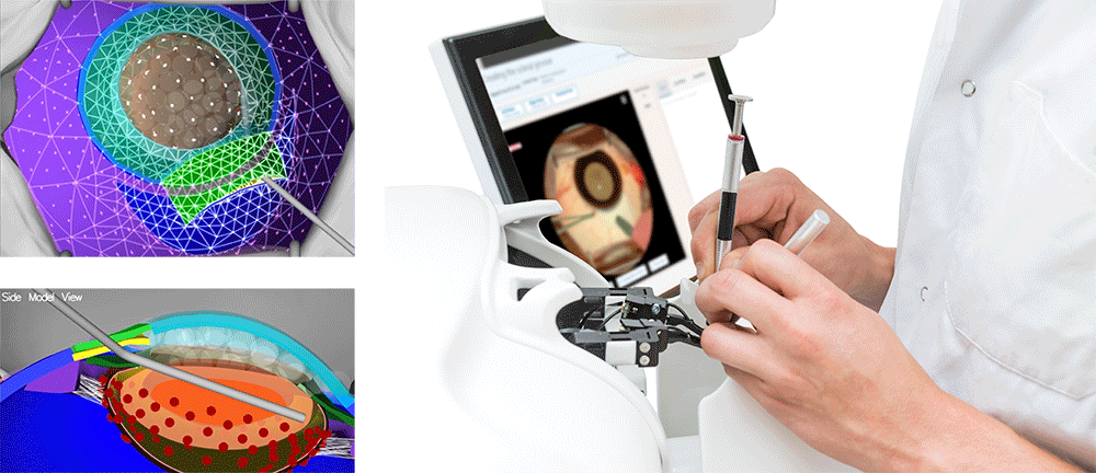 Cataract Surgery Simulator in Action